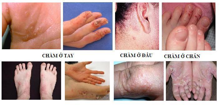 Hình ảnh bệnh Chàm - Eczema