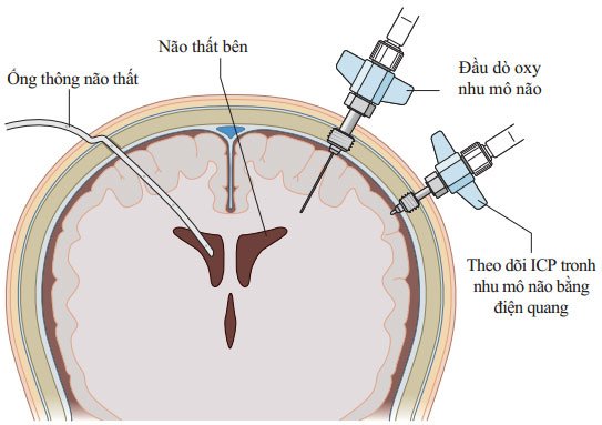 Theo dõi áp lực nội sọ và nhu mô não