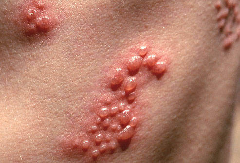 Hình ảnh bệnh Herpes