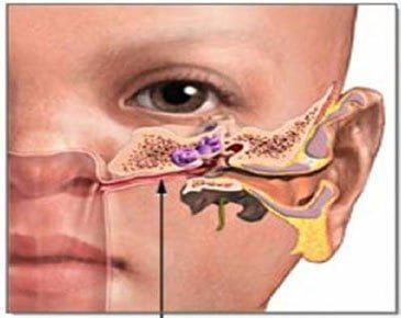 Dị vật ở trong tai thường gặp ở trẻ em