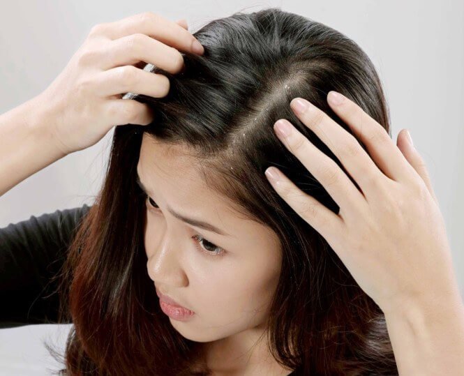 Người da đầu nhiều chất dầu thường hay bị gầu