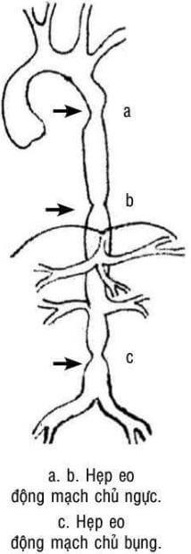 Sơ đồ hẹp eo động mạch chủ ở nhiều chỗ 