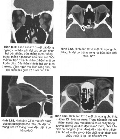 Hình ảnh CT ở mặt cắt đứng