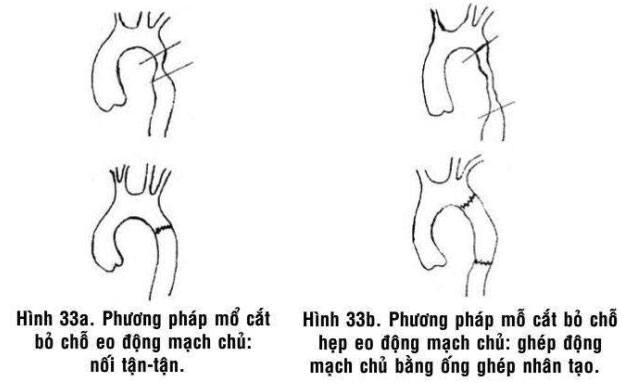 Bệnh hẹp eo động mạch chủ