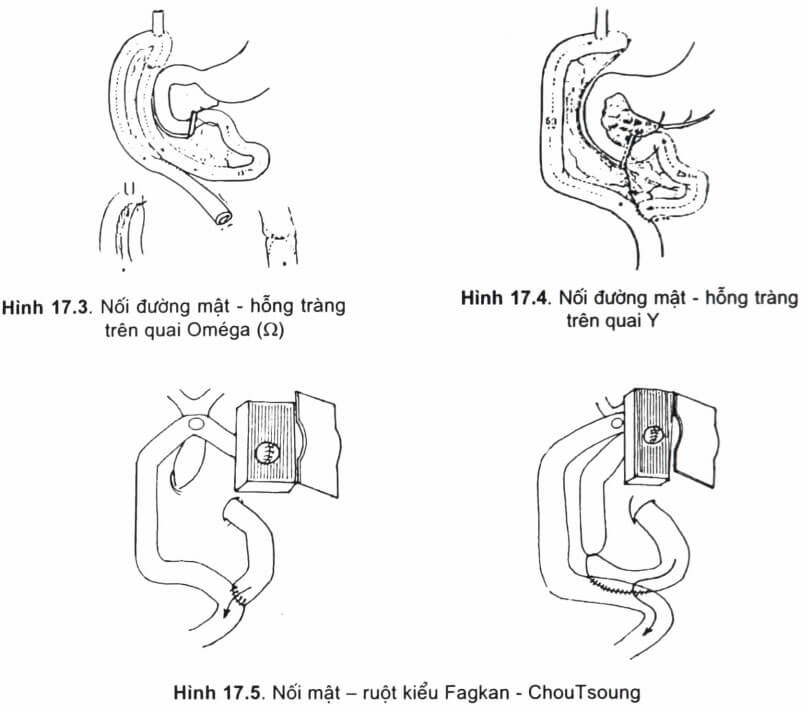 Mổ sỏi mật