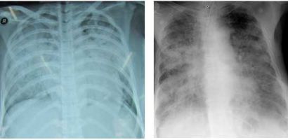 Hình ảnh tổn thương phổi ở người bệnh nhiễm cúm A HiNi