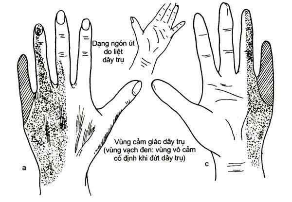 Thần kinh trụ có dấu hiệu bàn tay quắp