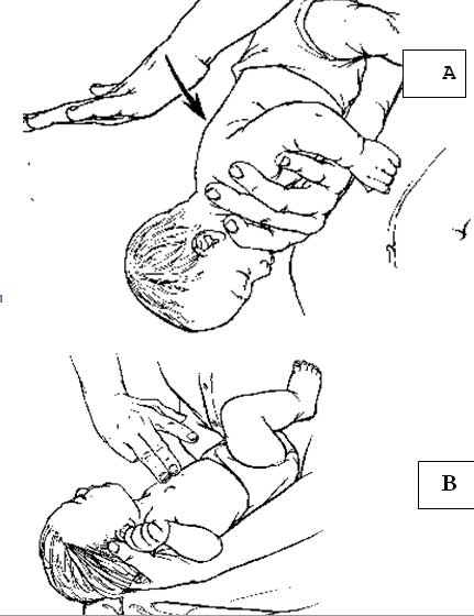 Kỹ thuật vỗ lưng (A) ép ngực (B) ở trẻ nhỏ