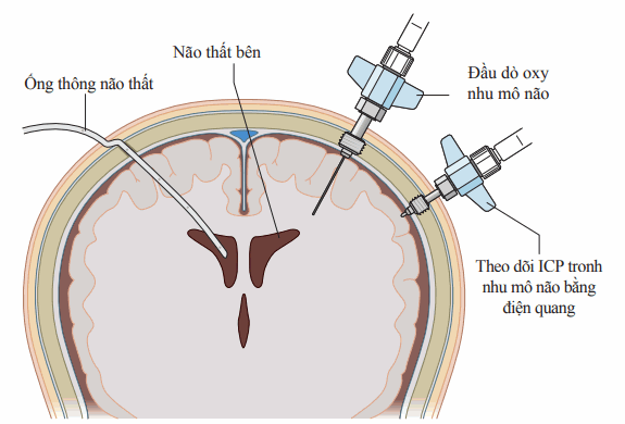 Theo dõi áp lực nội sọ